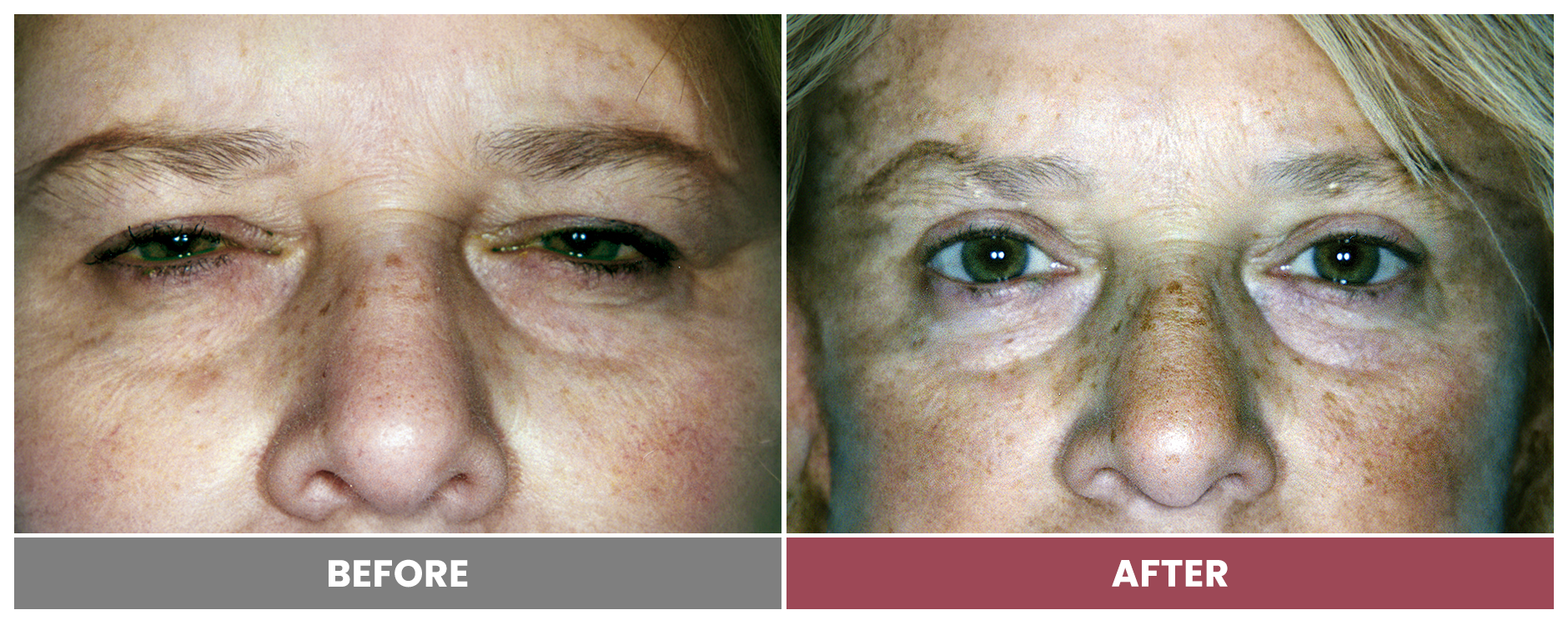 Upper Blepharoplasty - Case 29